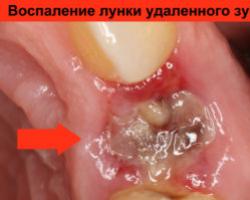 Удаление коренного зуба ― показания и особенности Если появился отек